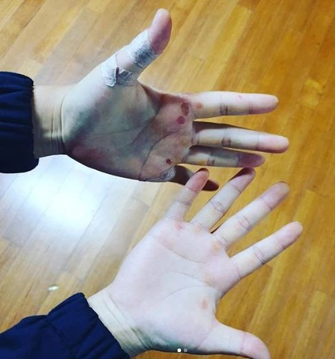 야구와 연애한다는 물집과 굳은 살이 박힌 김라경 손바닥 